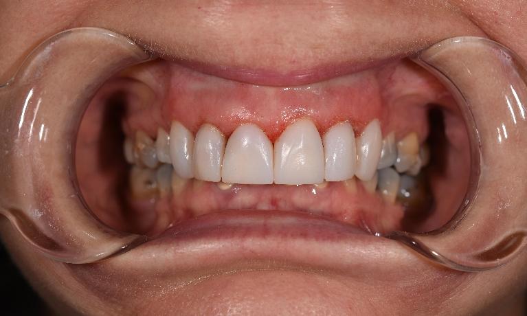Smile-Makeover-After-Image