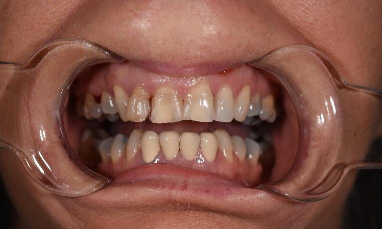 Smile-Makeover-Before-Image